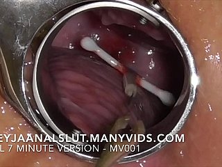 AMATEUR FREYJAANALSLUT: HAAR IUD VERWIJDEREN - Trek het uit Freyja's Cervix, waardoor haar weer vruchtbaar is - volledige versie op ManyVids